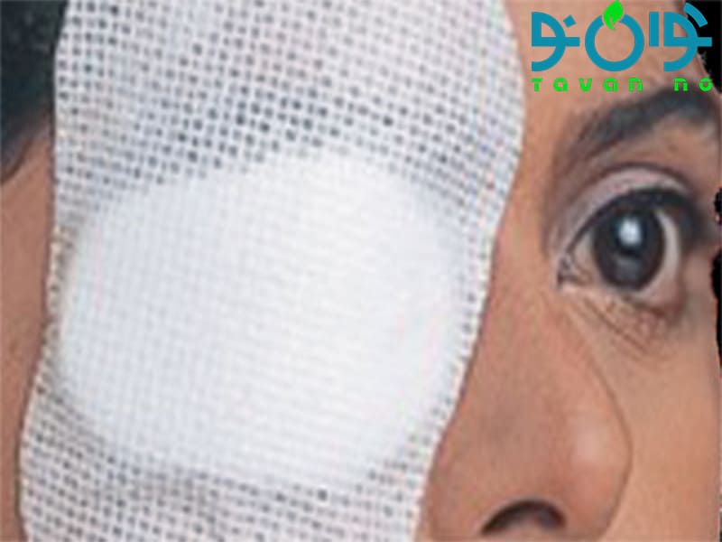 پد چشمی استریل و اهمیت آن در کنترل عفونت‌های چشمی